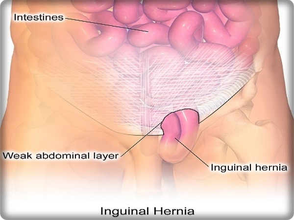 "الفتق الإربي" Inguinal hernia ، وأسبابه، وأعراضه